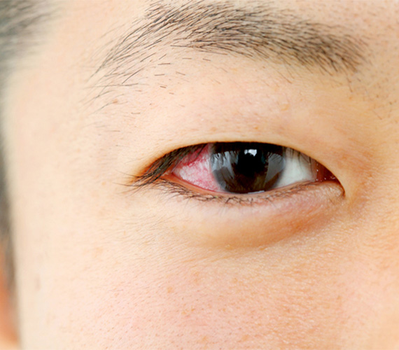 結膜炎・角膜炎