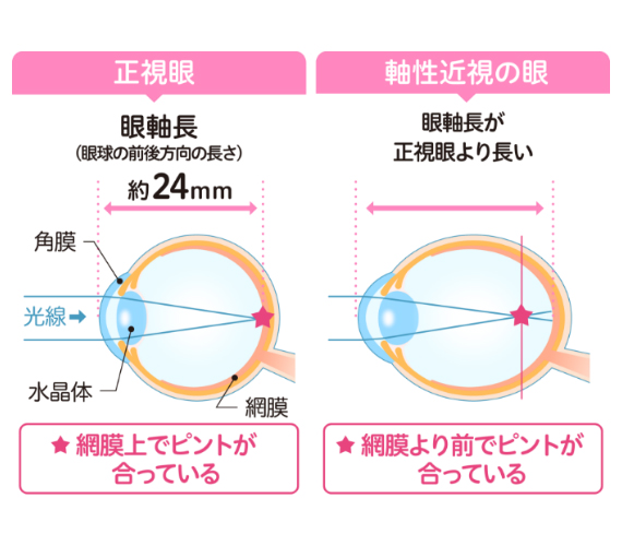 こどもの近視
